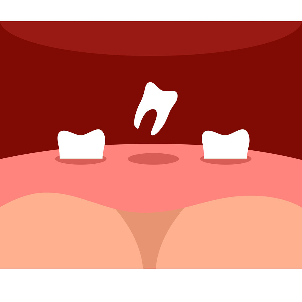 What Is A Dental Implant Foust Family Dental Care